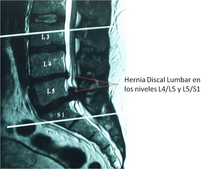 Hernia Discal cervical / Hernia Discal Lumbar